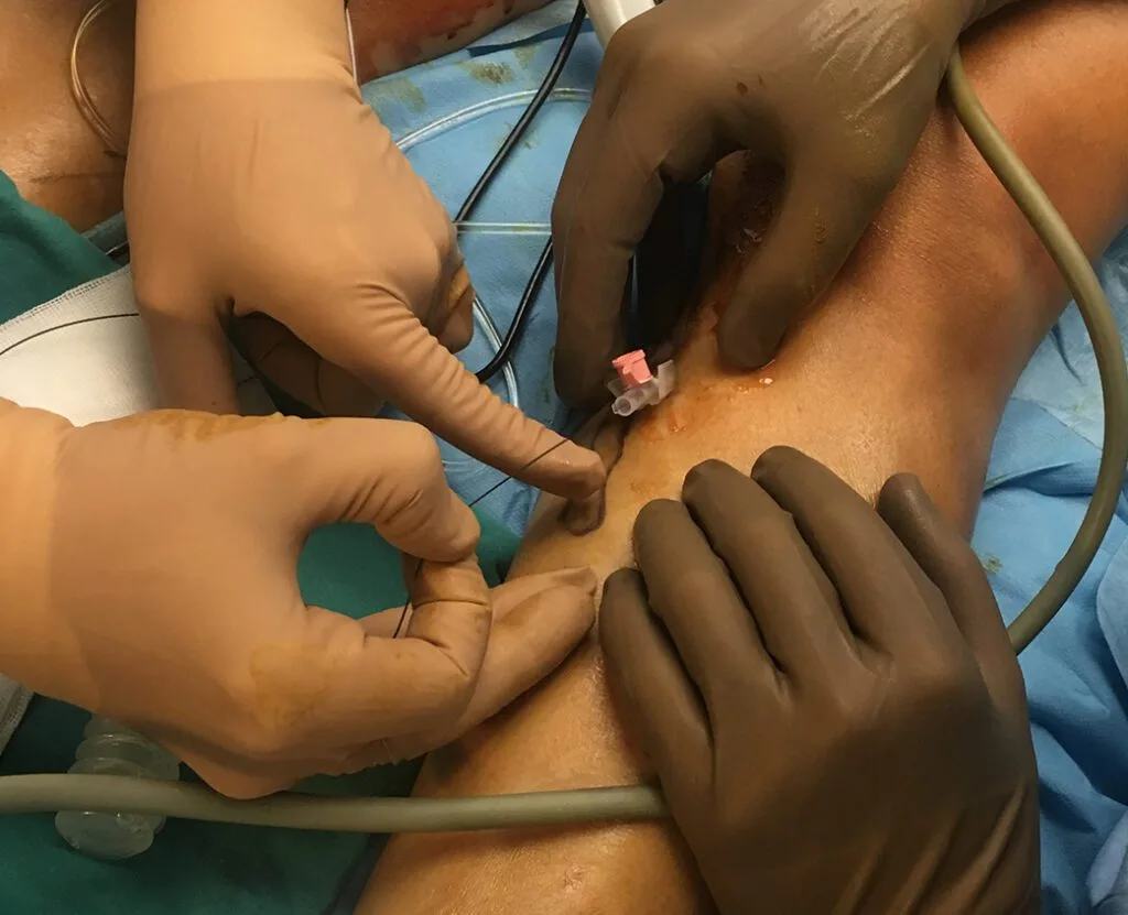 Endovenoz trunkal ablasyon - Prof. Dr. Semih Barlas