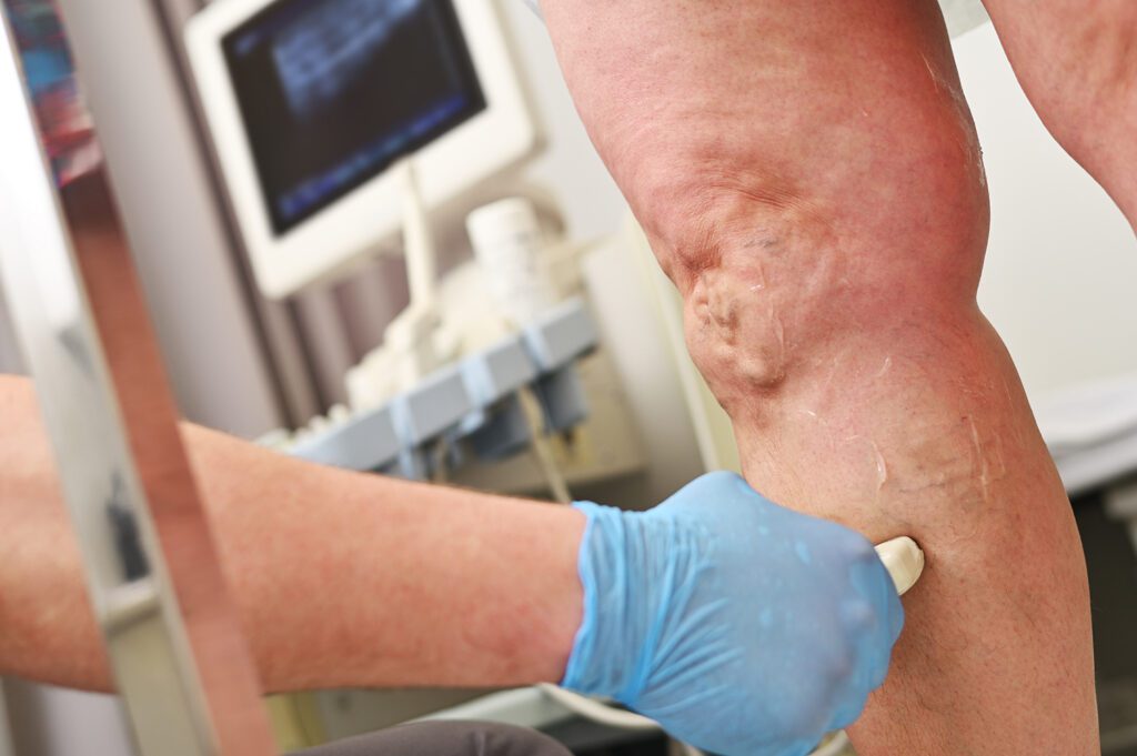 Endovenous trunkal ablation therapy