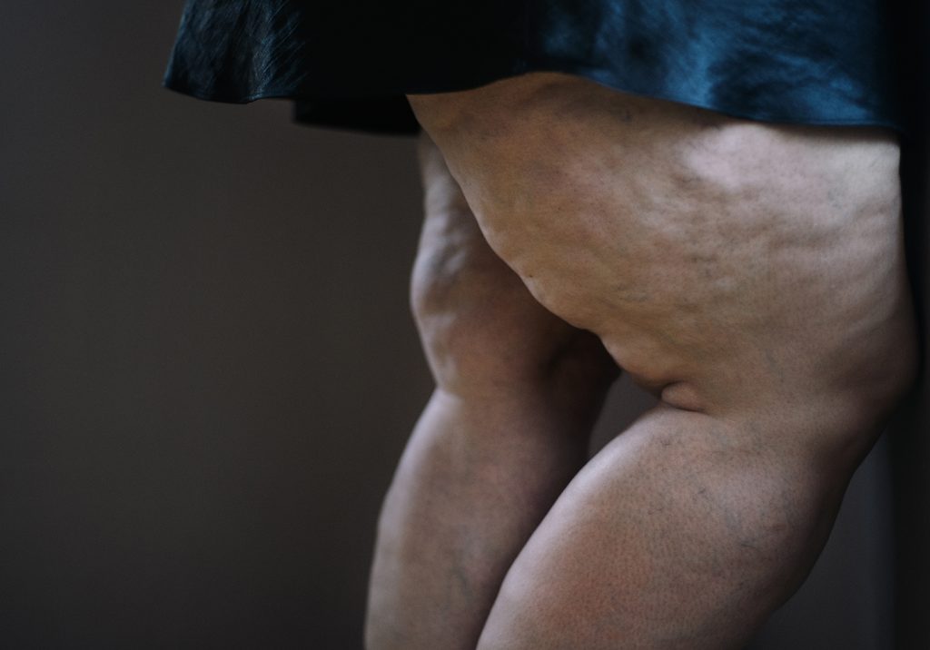leg illustration showing the differences between lipedema and varicose veins